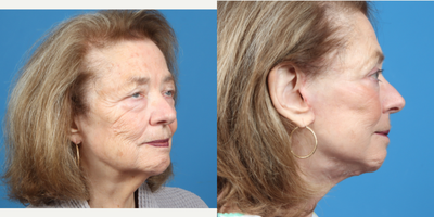 75 and up year old woman treated with Eyelid Surgery, Facelift, Facial Fat Transfer, Neck Lift - 75 and up year old woman treated with Eyelid Surgery, Facelift, Facial Fat Transfer, Neck Lift