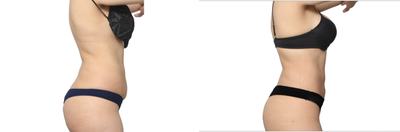 Woman treated with Smart Lipo - Woman treated with Smart Lipo through high definition lipo with liposculptureto lose belly fat and get some definition. She didn't want to lose weight because her butt would shrink.