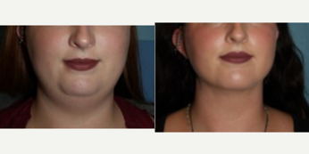 25-34 year old woman treated with Chin Liposuction, Liposuction, Liposculpture - This patient came to us with concerns about the fullness in her neck. Submental liposuction was performed. She has better contour of the neck and jaw line.