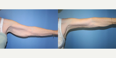 17 or under year old woman treated with Skin Rejuvenation - 17 or under year old woman treated with Skin Rejuvenation