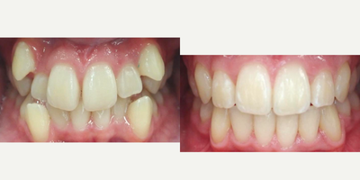 17 or under year old woman treated with Braces - Crowding improved with 2 years of treatment using traditional metal braces.