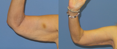 65-74 year old woman treated with Arm Lift - 74 year old female who is shown one year after an arm lift.