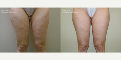 45-54 year old woman treated with Velashape - This patient in her late 40s had successfully lost weight, but wanted a solution to quickly tighten her skin and get rid of the pesky cellulite on her legs without the downtime of liposuction. She wanted to be able to show off her new figure but was still bothered by the bumpy appearance on her thighs. After consultation she decided Velashape was the best option for her. Velashape is the first and only FDA approved treatment that penetrates deep enough to treat cellulite and contour the body. It is a painless procedure, with no downtime, and you can see the results immediately.