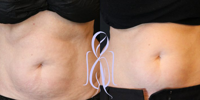 Woman treated with WarmSculpting with SculpSure - Woman treated with WarmSculpting with SculpSure