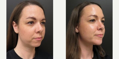 25-34 year old woman treated with Chin Implant, Rhinoplasty, Chin Liposuction - This patient underwent liposuction to her submental area, Rhinoplasty and Chin Implant
