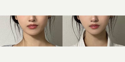 25-34 year old woman treated with Lipodissolve - Fat-dissolving injections to contour the jawline and cheeks.