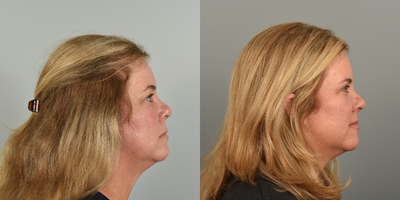 45-54 year old woman treated with Eyelid Surgery, CO2 Laser - This patient had the following procedures: upper blepharoplasty, lower lid pinch, and periorbital fractional CO2 laser. After photos are 3 months post op.