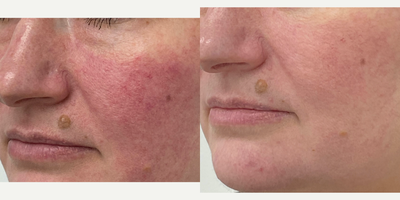 45-54 year old woman treated with Skin Rejuvenation, SkinCeuticals, Skin Lightening - Laser for rosacea