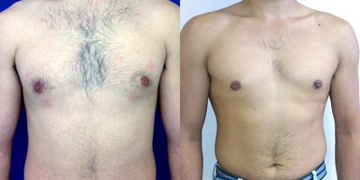 Case #Gynecomastia Patient - Awake gynecomastia procedure. good skin retraction. followed by increased excercise by patient, yields great results.