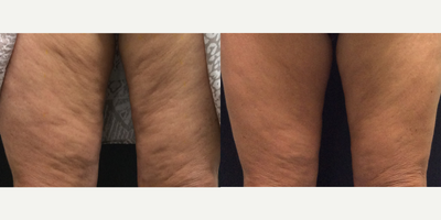55-64 year old woman treated with Velashape - VelaShape to thighs after four treatments with Cavendish Clinic.