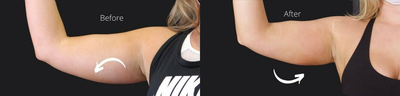 Woman treated with Cryoskin - Woman treated with Cryoskin