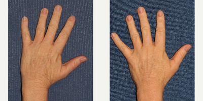 45-54 year old woman treated with Photodynamic Therapy - Woman treated with PDT for brown spots on her hands.