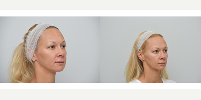 25-34 year old woman treated with PicoWay, Skin Rejuvenation, SkinCeuticals - Picoway Laser with combination of skin care by Skin Ceuticals was used to treat melasma and skin rejuvenation.