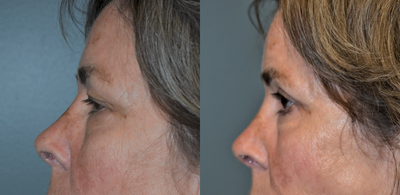 55-64 year old woman treated with Eyelid Surgery - This 60 year old woman felt her eyes made her look tired all the time. She had an upper and lower blepharoplasty, (eyelid lift), using CO2 laser. This after photo was taken at 8 months.
