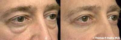 46 year old man treated with Eyelid Surgery - 46 year old man treated with Eyelid Surgery