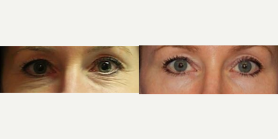 35-44 year old woman treated with Thermage - Patient was treated with an under eye Thermage