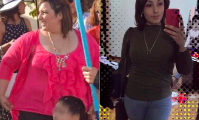 25-34 year old woman treated with Sleeve Gastrectomy - Mayra had the gastric sleeve with Dr. Rodolfo Wilhelmy, 2 years after and with a healthy lifestyle and a having exercise she is feeling GREAT. She lost over 130 lbs. Congratulations!