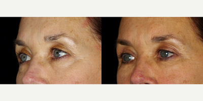 66 year old woman treated with Restylane Refyne - 66 year old woman treated with Restylane Refyne to undereye. Photos depict before and 2 months after treatment.