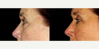 66 year old woman treated with Restylane Refyne - 66 year old woman treated with Restylane Refyne to undereye. Photos depict before and 2 months after treatment.