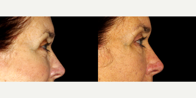 66 year old woman treated with Restylane Refyne - 66 year old woman treated with Restylane Refyne to undereye. Photos depict before and 2 months after treatment.