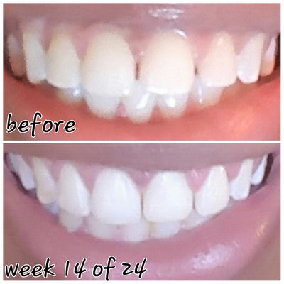 Overbite, Gaps, & Bite Issues - 24 Week Invisalign Journey - Invisalign ...