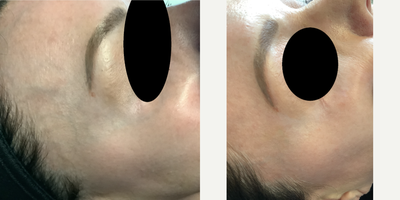 Woman treated with Asclera - Female patient 2 weeks post-op one sessions of Face Sclerotherapy