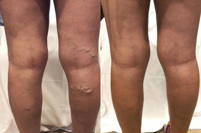 35-44 year old woman treated with Varithena - This patient's unsightly and painful varicose veins disappeared with just one injection of Varithena. Varithena is a chemical used in ablations for torturous varicose veins. The chemical is injected into the vein through a small needle. The procedure is quick, painless, and very minimally invasive.