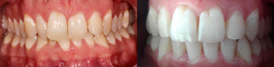 Treated with Six Month Smiles - 3.5 Months Invisalign alignment with acceleration