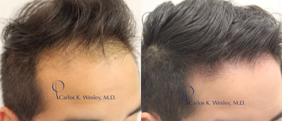 25-34 year old man treated with PRP for Hair Loss - Patient treated with PRP for Hair loss