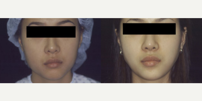Woman treated with Jaw Reduction - Woman treated with Jaw Reduction