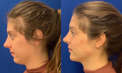 Woman treated with Restylane Lyft - My patient desired a more chiseled chin and jawline. I used 2 Radiesse on the chin and jawline and Restylane Lyft to her cheekbones.
