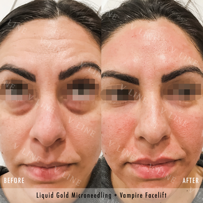 25-34 year old woman treated with Vampire Facelift - Vampire Facelifts are great way to add more volume to your face and firm up skin. This before & after, is right after her treatment so her skin still needs some recovery time but believe you me, she will be glowing in a few days! :)