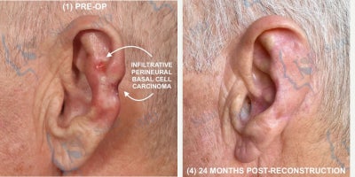 65-74 year old man treated with Mohs Surgery - This patient had a history of BCC on both of his ears and had undergone Mohs surgery before, leaving the structure of his helix damaged. This multi-stage reconstruction consisted of using pre-laminated cartilage to perform a retroauricular interpolation flap. The patient is incredibly happy with his results and is thrilled that he can still wear his hearing aids.