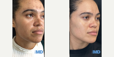 25-34 year old woman treated with Pico Genesis, Skin Rejuvenation, Skin Lightening - This young lady saw amazing results for her skin after our combo of PICO genesis and DiamondGlow Facial!!