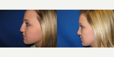 25-34 year old woman treated with Rhinoplasty - 25-34 year old woman treated with Rhinoplasty