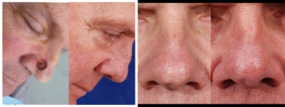 Right nasal cancer defect reconstruction - Right nasal sidewall defect from Mohs surgery to remove a basal cell carcinoma.  Repair completed with bilobed flap.