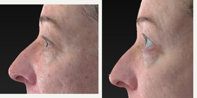 45-54 year old woman treated with Skin Tightening - Again we used our tyte and bryte unique treatment to improve and tighten this womans skin around her eyes.