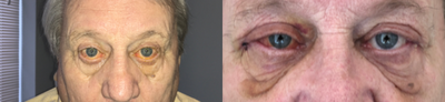 65-74 year old man treated with AlloDerm - Male treated for lower lid retraction