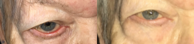 65-74 year old man treated with AlloDerm - Lower Lid Ectropion/Retraction Repair