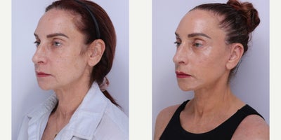 55-64 year old woman treated with Facelift, Neck Lift, Brow Lift, Facial Fat Transfer, CO2 Laser - 59 year old patient is 2 months post op: Facelift, Neck lift, Temporal Brow lift, facial fat transfer and co2 laser with Dr. Madnani.