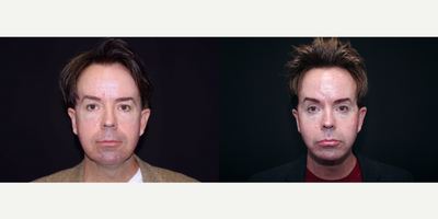 45-54 year old man treated with Facelift, Browlift, Fat Transfer, Genioplasty and Cheek Implants - 53 year old male received a facelift, browlift, fat transfer, genioplasty (chin augmentation) and cheek implants; photos depict the patient's results 3 months post-op.