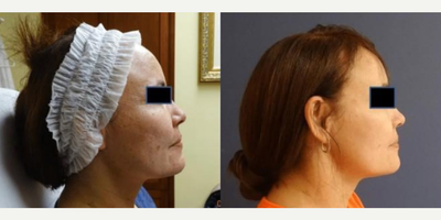 Woman treated with Fractora RF - Fractora face+neck