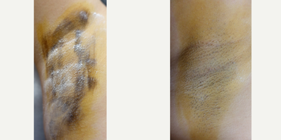 25-34 year old woman treated with miraDry - Patient Iodine starch test shown before miraDry treatment and 2 weeks after 1 treatment for permanent underarm sweat and odor reduction. 
An iodine solution is applied to the skin and allowed to air-dry. Once dry the area is dusted with cornstarch or potato flour. When sweat reaches the surface of the skin the starch and iodine combine causing a dramatic color change (yellow -&gt; dark blue) allowing sweat production to be actively visualized.