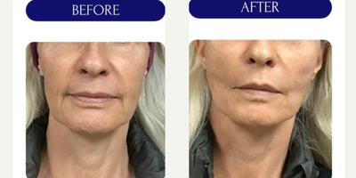 55-64 year old woman treated with Thread Lift, MINT threadlift - mint threadlift