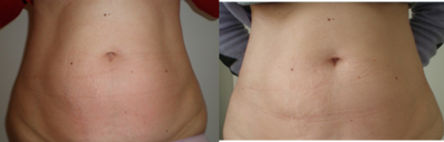 TriPollar - 
	Woman, 39 years old. Tummy skin tightening and fat reduction after 3 treatments. Photos supplied by manufacturer, Pollogen Ltd, All Rights Reserved.
