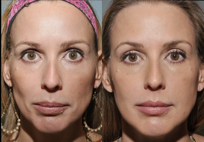 Young woman had decreased volume - 
	This patient had decreased volume throughout her face. With the use of Sculptra Aesthetic, Dr Robinson was able was able to recreate the fullness in the patients face.
