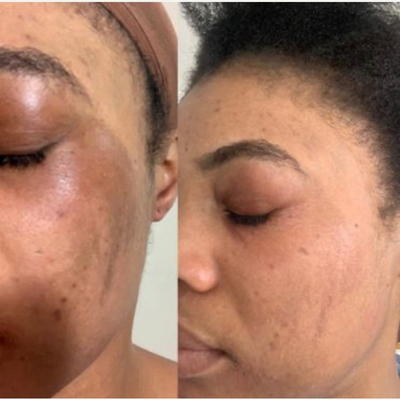 25-34 year old woman treated with Obagi Nu-Derm - Before and after pigmentation treatment