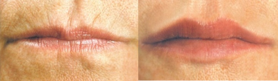 Lip enhancement - 
	Dr Groff treats the patient with Juvederm to enhance her lips.
