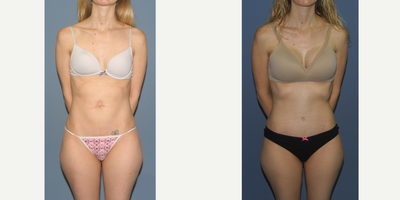 35-44 year old woman treated with Tummy Tuck Revision - Tummy tuck was used to correct an unesthetic belly button from a previous umbilical hernia repair