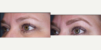 Microblading - Cosmetic tattooing is a procedure that tattoos pigment onto areas of the face that mimics the appearance of makeup. Cosmetic tattoos are used by people who have sensitivity or allergies to traditional cosmetics, people with difficulty seeing, and patients who are unable to apply makeup due to conditions like arthritis or Parkinsons disease. In addition, it is also beneficial for those who do not have facial hair due to allergies, hair pulling, or aging and genetics. After the areas of the face receive cosmetic tattoos, the makeup becomes semi-permanent and will not wash off from water, cleansers, or sweat. Cosmetic Tattooing is usually applied to the eyebrows, upper and lower eyelashes, and the lips.
